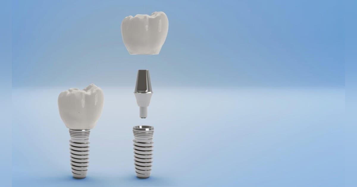 Gunbarrel Dental Center Releases Clinical Guidance on In-Office vs. Take-Home Teeth Whitening for Boulder Patients
