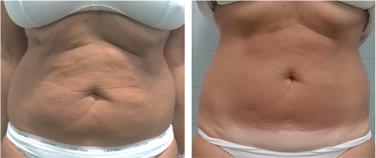 Ovation Med Spa Upgrades Body Contouring with BodyEstiq™ Onda Coolwaves® Technology