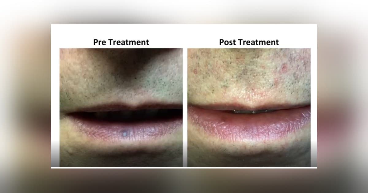Vascular Surgeon Offers Laser Treatment for Venous Lake, a Common but Often Misunderstood Lip Lesion