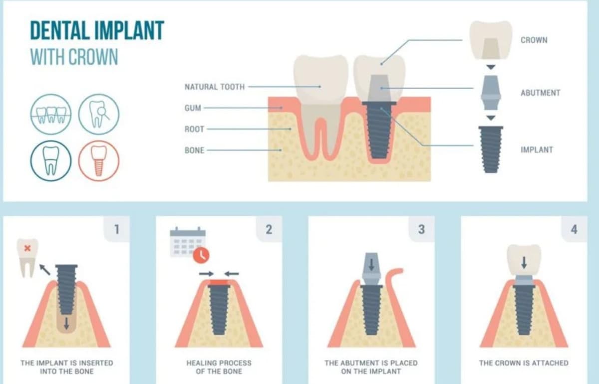 Fort Worth Dentist Offers Affordable Dental Implants Without Sacrificing Quality
